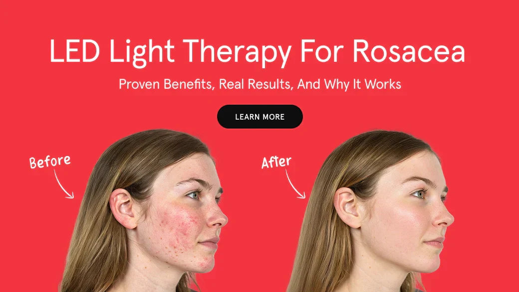 LED Light Therapy for Rosacea: Proven Benefits, Real Results, and Why It Works