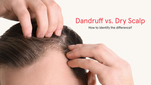 Dandruff versus Dry Scalp. How to identify the difference? Image banner shows a close up shot of a man's scalp with dandruff.