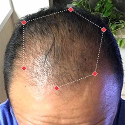 Top down view after image of a man with thicker hair at frontal region of his hair.