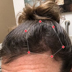After image of a woman showing the her temples with more thicker hair.