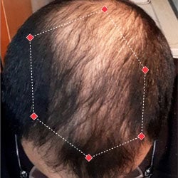 Top down view after image of a man with thicker hair at the crown and frontal region of his hair.