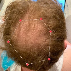 Top down view before image of a man with a thinning hair in his crown.