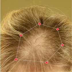 Top down view before image of a woman with bald spot at the frontal region of her hair.