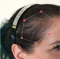 Before image of a woman showing the thinning hair at her temples.