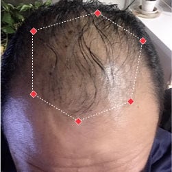 Top down view before image of a man with thinning hair at the frontal region of his hair.