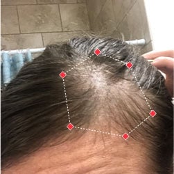 Before image of a woman showing the thinning hair at her temples.