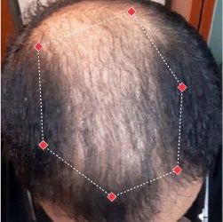 Top down view before image of a man with thinning hair at the crown and frontal region of his hair.