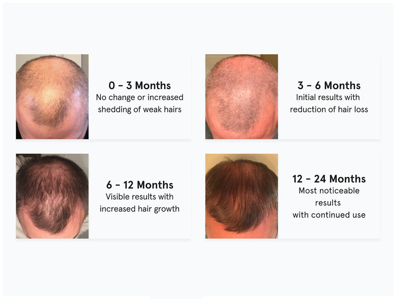 Before and After Images showing the progress of hair growth of a man experiencing a thinning hair on his crown. 3 to 6 months progress of a man that shows his crown with growing baby hairs. 6 to 12 months progress shows a thicker hair at the crown and frontal region of his hair. 12 to 24 months progress shows his crown now have a more thicker hair.