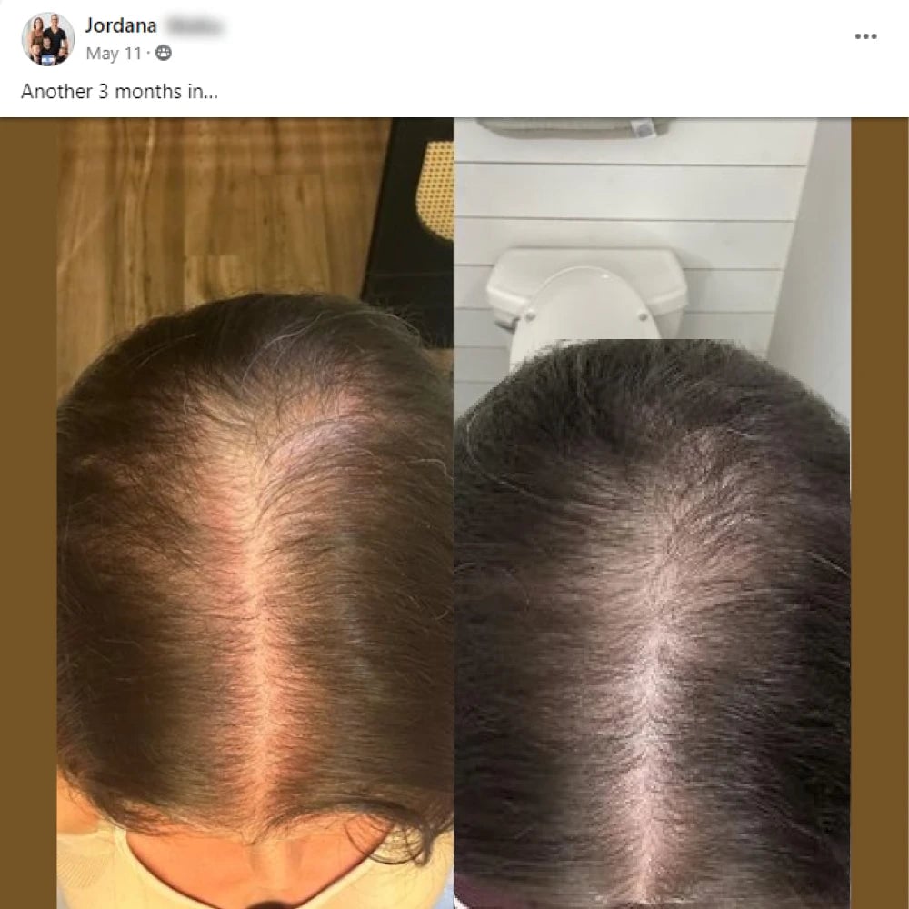 A facebook post from Jordana on May 11th. Another 3 months in. This post shows before and after images with the before showing a widening hairline of a woman and the after showing the hairline starts to fill in.