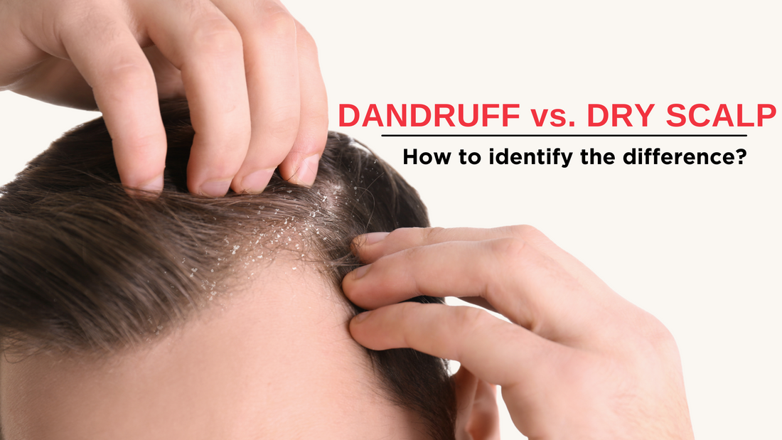 Dandruff vs. Dry Scalp: How to identify the difference?