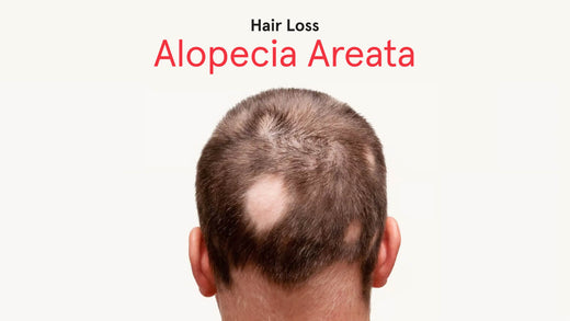Alopecia Areata. Image banner shows a close up sot of a man's head with multiple bald spots.