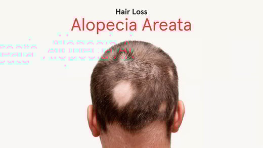 Alopecia Areata. Image banner shows a close up sot of a man's head with multiple bald spots.
