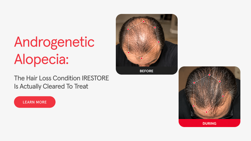 Androgenetic Alopecia: The Hair Loss Condition iRESTORE Is Actually Cleared to Treat