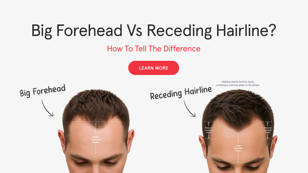 Big Forehead vs Receding Hairline? How to Tell the Difference