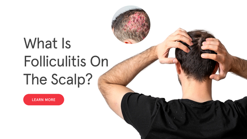 What Is Folliculitis on the Scalp? Symptoms, Causes, and When to See a Dermatologist