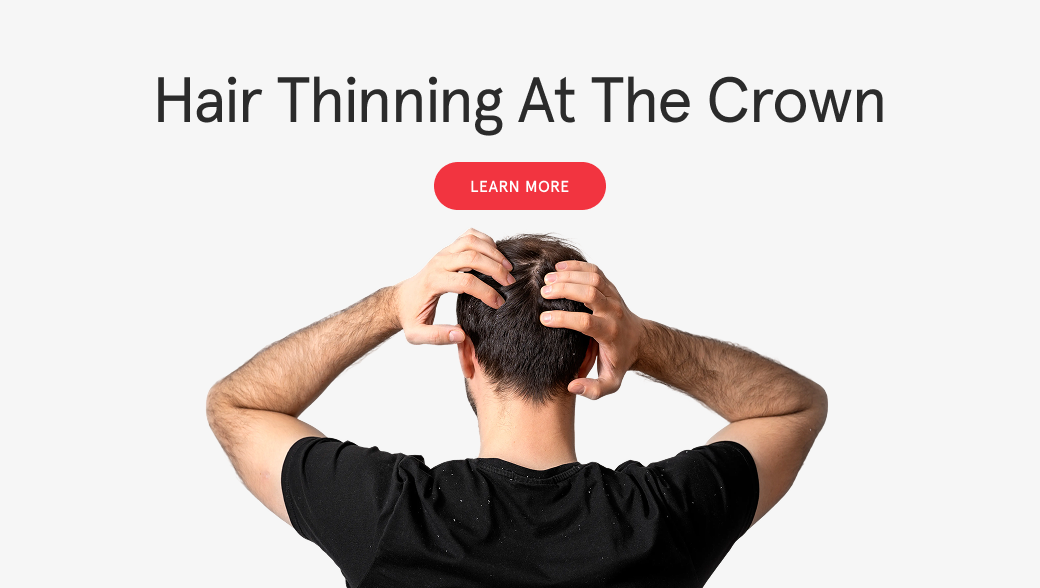 Why Is My Hair Thinning at the Crown? Early Signs & Fixes