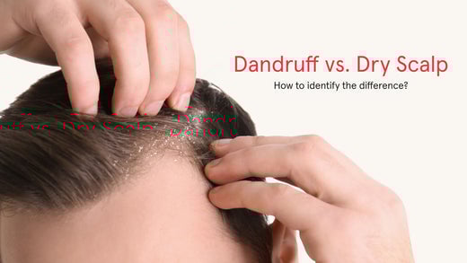 Dandruff versus Dry Scalp. How to identify the difference? Image banner shows a close up shot of a man's scalp with dandruff.