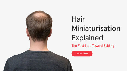 Hair Miniaturization Explained: The First Step Toward Balding
