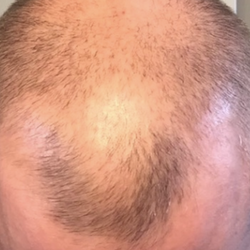 Top down view before image of a man with thinning hair at the crown and frontal region of his hair.