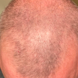 Top down view 3 to 6 months progress of a man that shows growing baby hairs at the crown and frontal region of his hair.