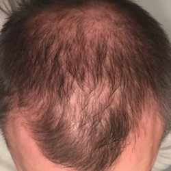 Top down view 6 to 12 months progress of a man that shows a thicker hair at the crown and frontal region of his hair.