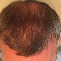 Top down view after image with 12 to 24 months progress of a man that shows his crown and frontal region of hair with a more thicker hair.