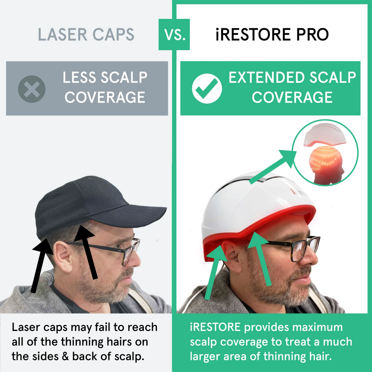 An image comparing the iRESTORE Professional with other laser cap. Laser caps only have less scalp coverage, laser caps may fail to reach all of the thinning hairs on the sides and back of scalp. While the Professional device have extended scalp coverage. it provides maximum scalp coverage to treat a much larger area of thinning hair.
