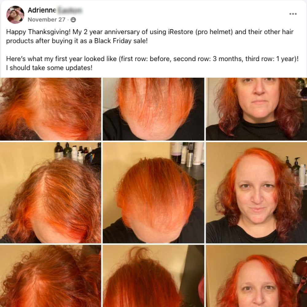 Happy Thanksgiving! My 2 year anniversary of using iRestore (pro helmet) and their other hair products after buying it as a Black Friday sale!
Here’s what my first year looked like (first row: before, second row: 3 months, third row: 1 year)! I should take some updates!