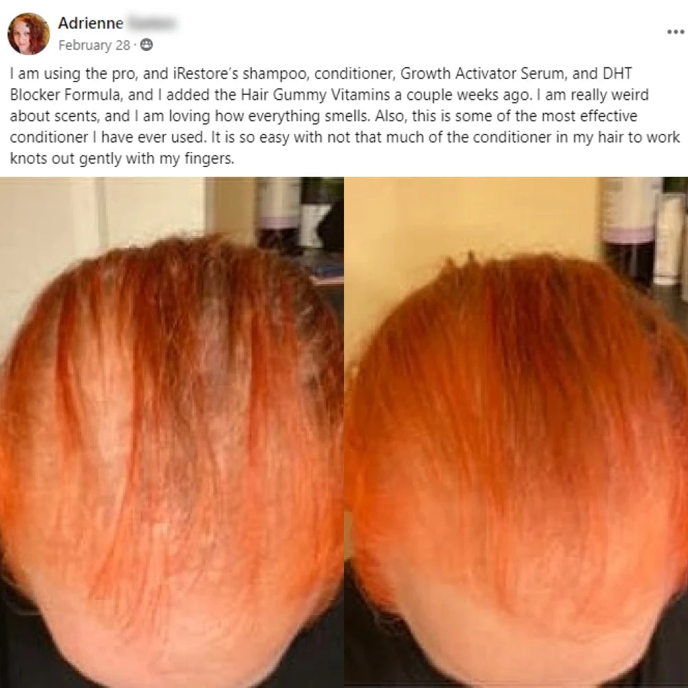 A facebook post from Adrienne on February 28th. I am using the pro, and iRestore’s shampoo, conditioner, Growth Activator Serum, and DHT Blocker Formula, and I added the Hair Gummy Vitamins a couple weeks ago. I am really weird about scents, and I am loving how everything smells. Also, this is some of the most effective conditioner I have ever used. It is so easy with not that much of the conditioner in my hair to work knots out gently with my fingers. This post shows before and after images.