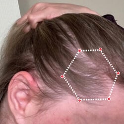 After image of a woman showing the her temples with more thicker hair.