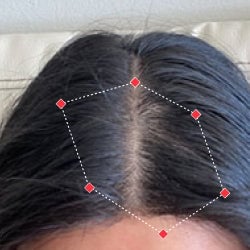 Top down view after image of a woman showing her bald spots started to fill in at frontal region of hair.