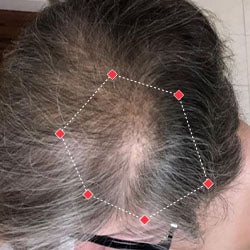 Top down view after image of a woman showing her hairline with growing more hair that fills the gap between her hairline. 