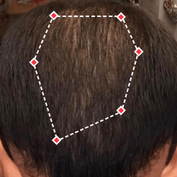Top down view after image of a man with thicker hair at his crown.