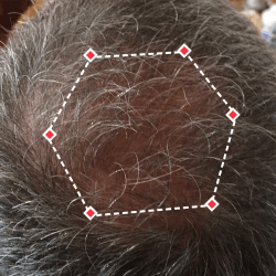 Top down view after image of a man with thicker hair at his crown.
