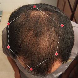 Top down view after image of a man with thicker hair at the crown and frontal region of his hair.
