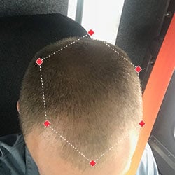 Top down view after image of a man with thicker hair at the crown and frontal region of his hair.
