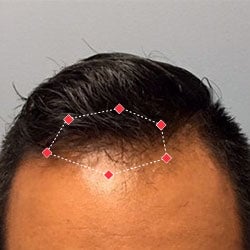 After image of a man showing his receding hairline starting to fill in.