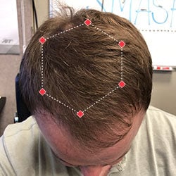 Top down view after image of a man with thicker hair at his crown.