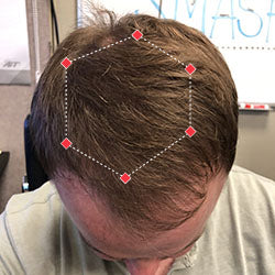 Top down view after image of a man with thicker hair at his crown.