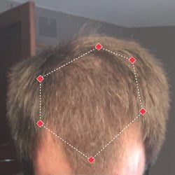 Top down view after image of a man with thicker hair at the frontal region of his hair.