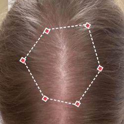 Top down view after image of a woman showing her hairline with growing more hair that fills the gap between her hairline. 