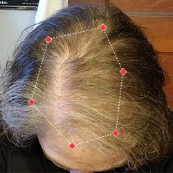 Top down view after image of a woman with thicker hair in her hairline.