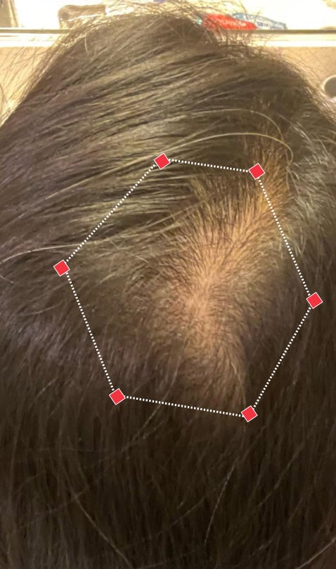 Top down view after image of a woman showing her hairline with growing more hair that fills the gap between her hairline. 