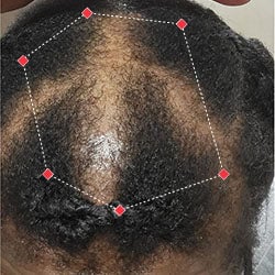 Top down view after image of a woman with showing her bald spots starting to fill in with baby hairs.