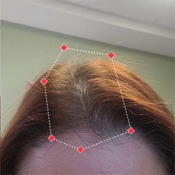 Top down view after image of a woman showing her hairline with growing more hair that fills the gap between her hairline. 