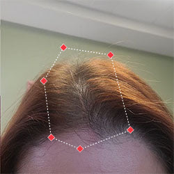 Top down view after image of a woman showing her hairline with growing more hair that fills the gap between her hairline. 