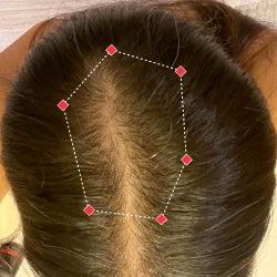 Top down view after image of a woman showing her hairline with growing more hair that fills the gap between her hairline.