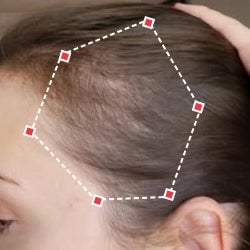 After image of a woman showing the her temples with more thicker hair.