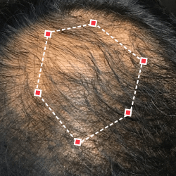 Top down view after image of a man with thicker hair at his crown.