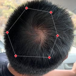 Top down view after image of a man  with thicker hair on his crown.